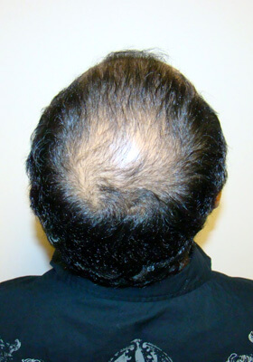 hair transplant photos