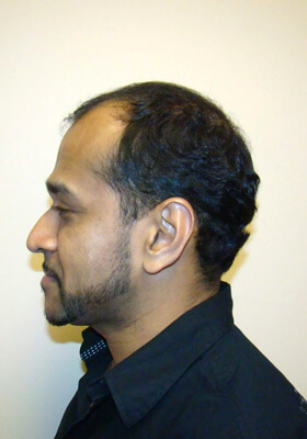 hair transplant photos