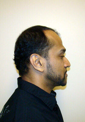 hair transplant photos