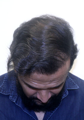 hair transplant before after Photos