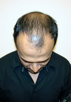 hair transplant photos