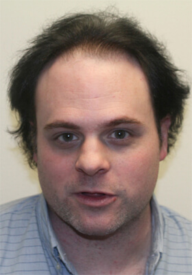 hair transplant photos