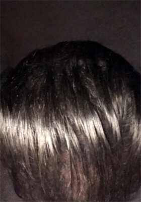 hair transplant photos