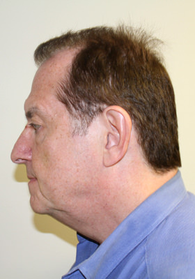 hair transplant photos