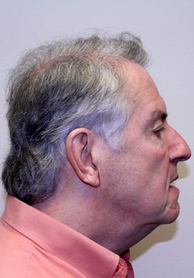 hair transplant photos