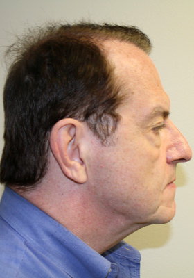 hair transplant photos