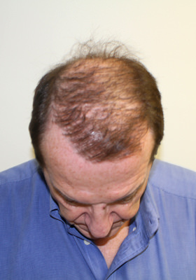 hair transplant photos