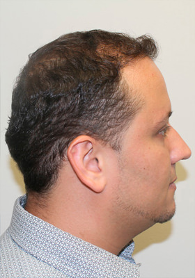 hair transplant photos