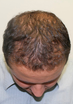 hair transplant photos