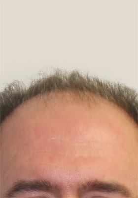 hair transplant photos