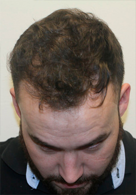 hair transplant before after Photos