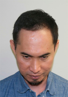 hair transplant photos