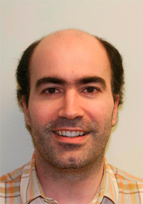 hair transplant photos