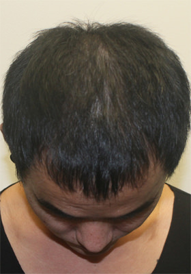 hair transplant before after Photos