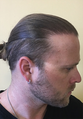 hair transplant photos