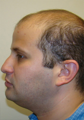 hair transplant photos