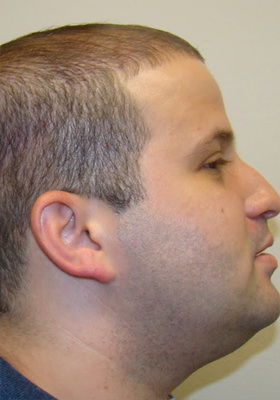 hair transplant photos