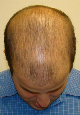 hair transplant photos