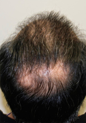 hair transplant photos