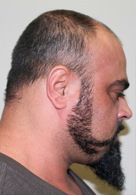 hair transplant photos