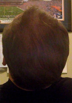 hair transplant photos