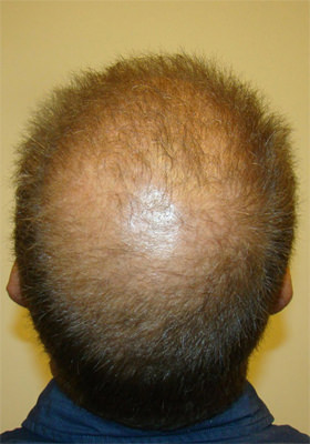 hair transplant photos