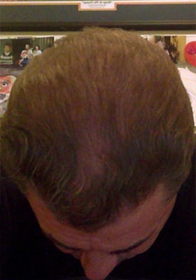 hair transplant photos