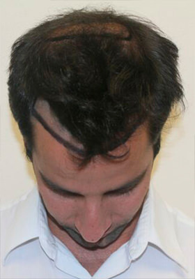 hair transplant before after Photos