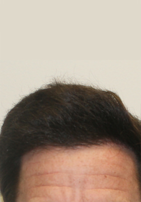 hair transplant before after Photos