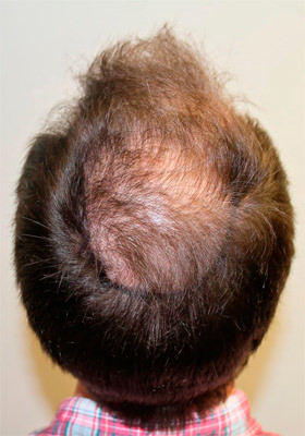 hair transplant photos