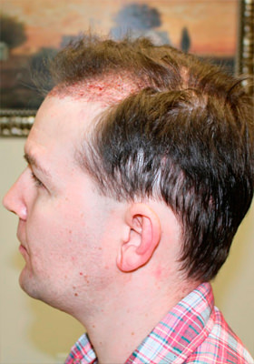 hair transplant photos