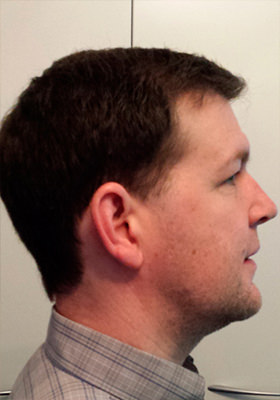 hair transplant photos