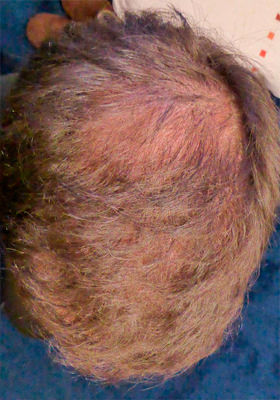 hair transplant before after Photos