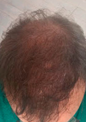 hair transplant photos