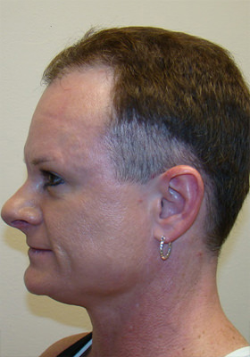 hair transplant photos