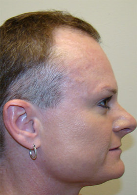 hair transplant photos