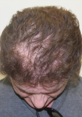 hair transplant photos