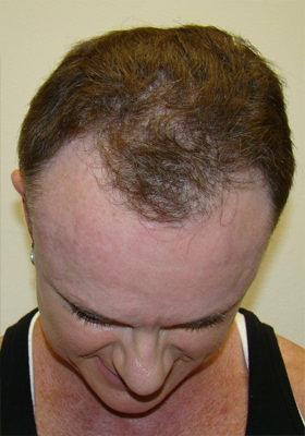 hair transplant before after Photos