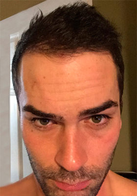 hair transplant photos