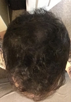 hair transplant photos