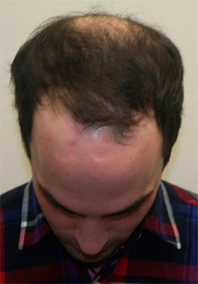 hair transplant before after Photos