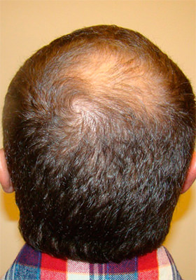 hair transplant before after Photos