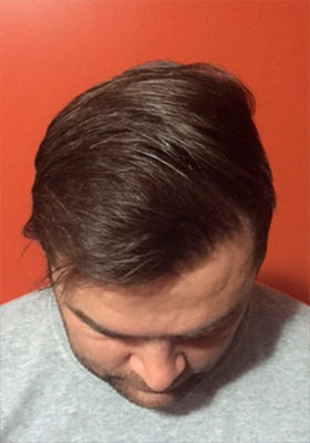 hair transplant photos