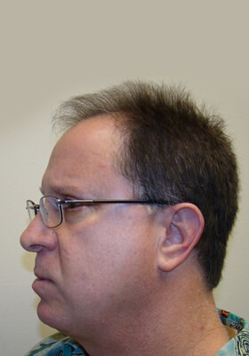 hair transplant photos