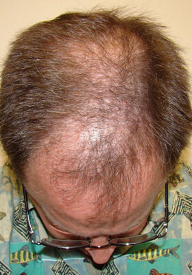 hair transplant photos