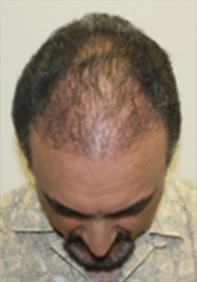 hair transplant photos