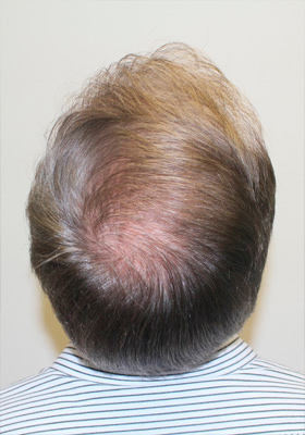 hair transplant before after Photos