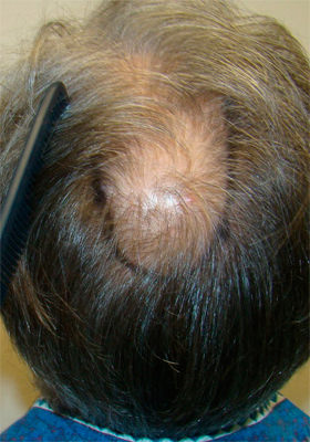 hair transplant before after Photos