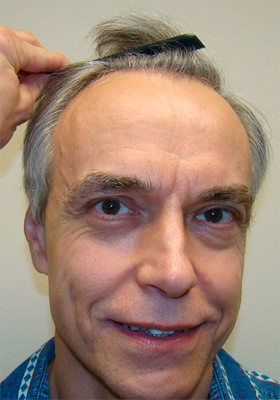 hair transplant photos