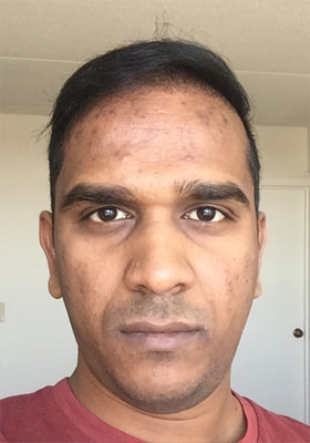 hair transplant photos